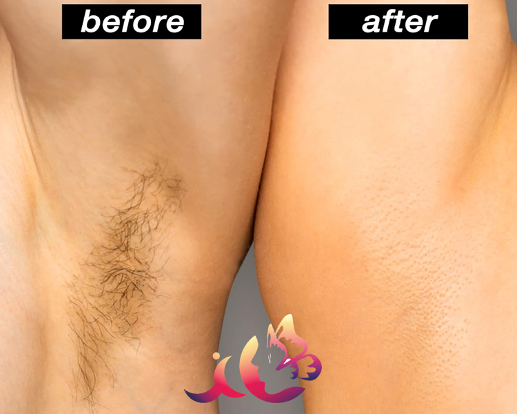 Saghar Taksim’de Epilasyon Kalıcı ve Acısız Bir Çözüm